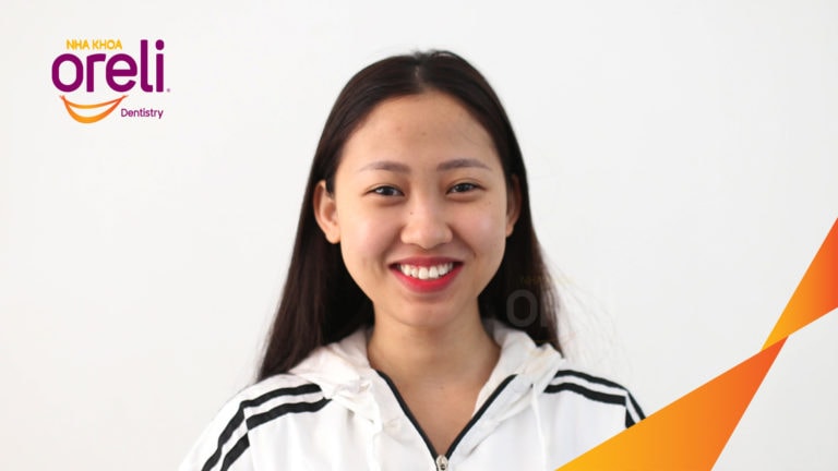 Ca niềng chỉnh hô nhổ 4r4 cho nụ cười hài hòa kết quả thực tế tại Oreli