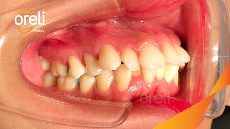 Ca niềng chỉnh hô nhổ 4r4 cho nụ cười hài hòa kết quả thực tế tại Oreli