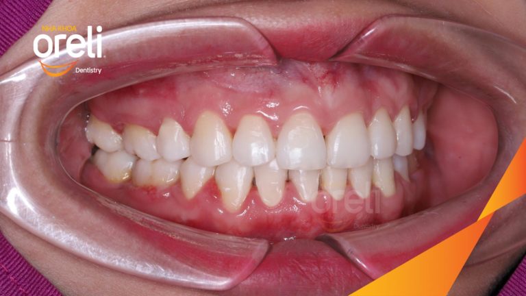 Ca niềng chỉnh hô nhổ 4r4 cho nụ cười hài hòa kết quả thực tế tại Oreli