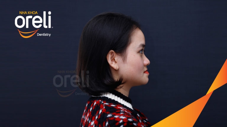 Ca niềng chỉnh móm nặng kết quả thực tế tại Nha khoa Oreli