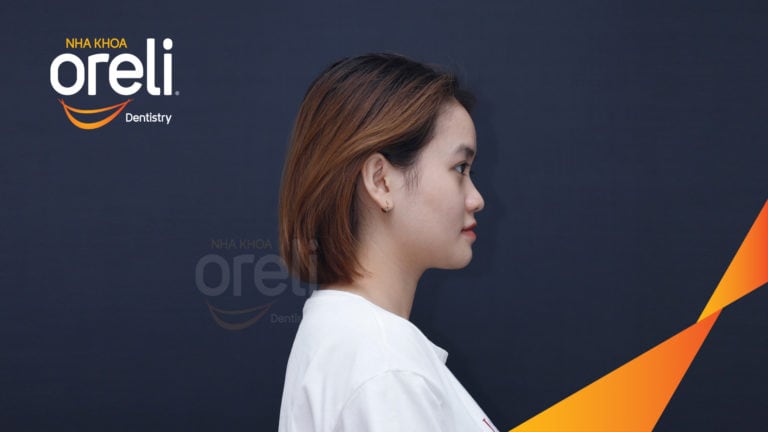 Ca niềng chỉnh móm nặng kết quả thực tế tại Nha khoa Oreli