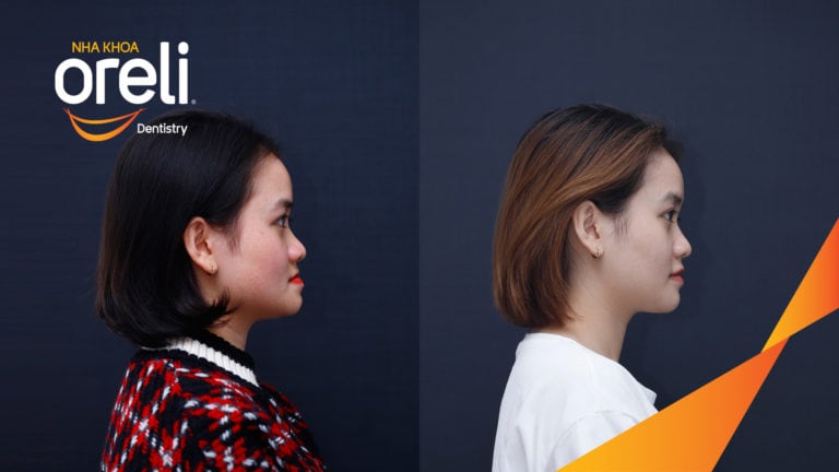 nieng rang mom uy tin nha khoa oreli