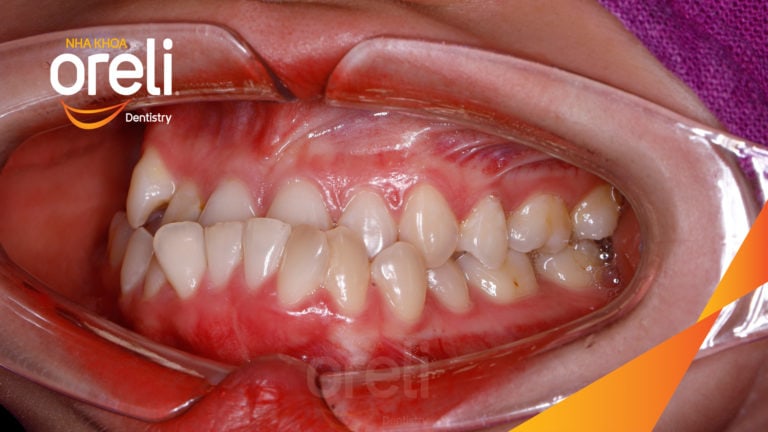 Ca niềng chỉnh móm nặng kết quả thực tế tại Nha khoa Oreli