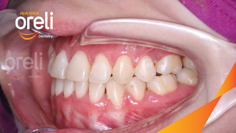 Ca niềng chỉnh móm nặng kết quả thực tế tại Nha khoa Oreli
