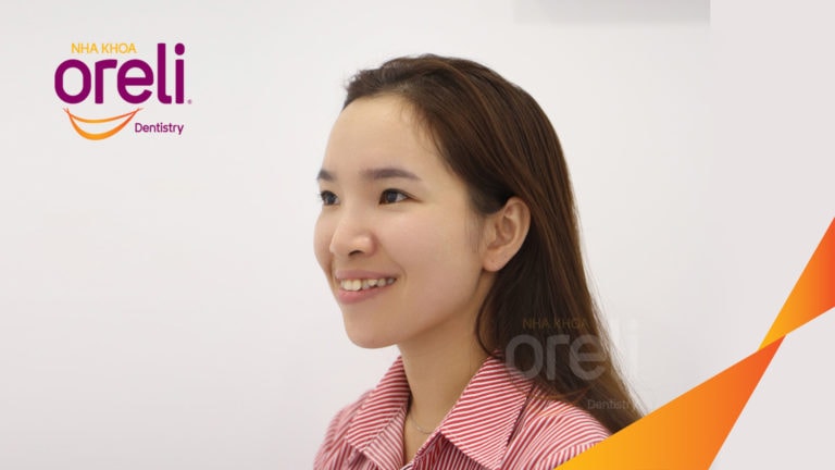 Ca niềng răng hô chen chúc có nhổ 4r4 kết quả sau 3 năm tại Oreli