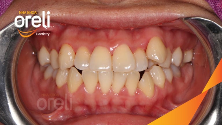 Ca niềng răng hô chen chúc có nhổ 4r4 kết quả sau 3 năm tại Oreli
