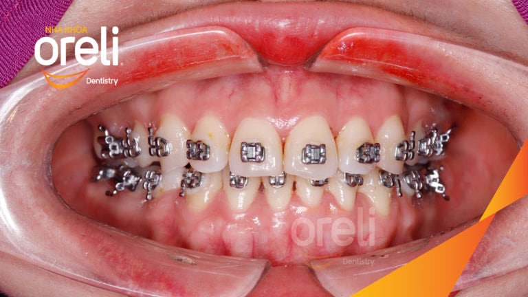 nieng rang ho oreli uy tin bmt