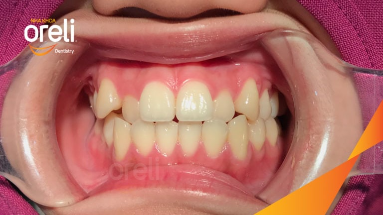 nieng rang ho oreli uy tin