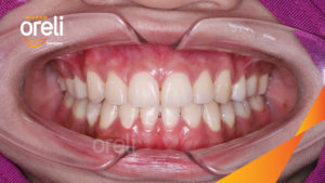 nieng rang ho oreli uy tin