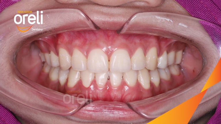 nieng rang ho oreli uy tin