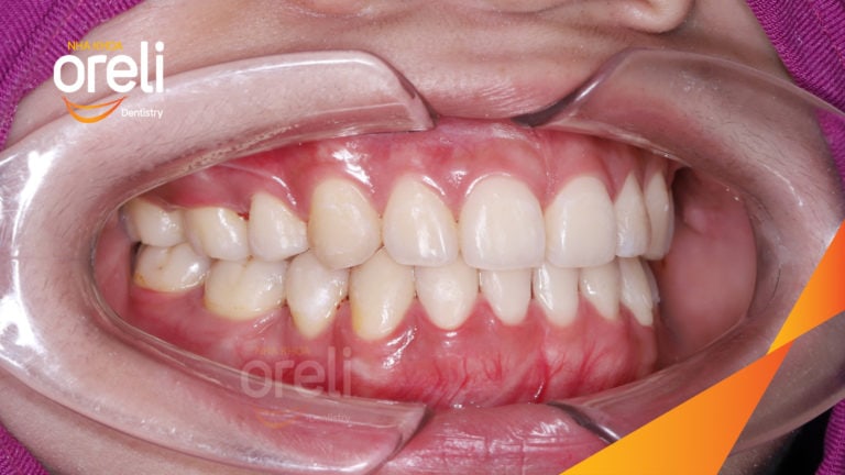 nieng rang ho oreli uy tin