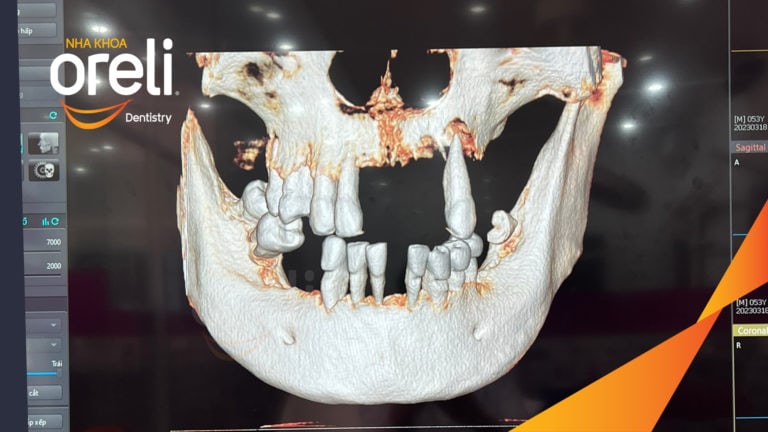 Trồng răng all on four hàm trên và dưới – Khôi phục ăn nhai trở lại | Oreli