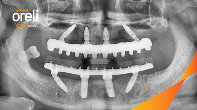 Trồng răng all on four hàm trên và dưới – Khôi phục ăn nhai trở lại | Oreli