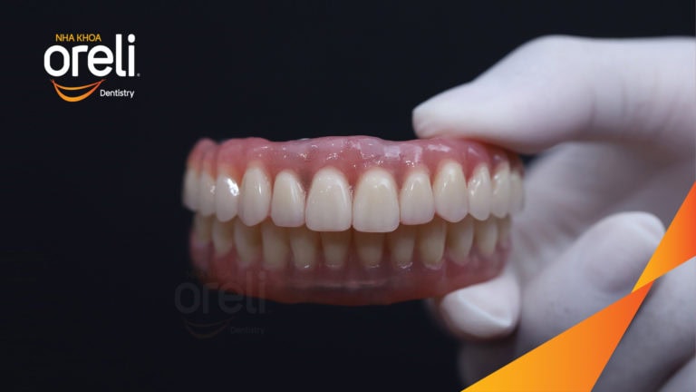 Trồng răng all on four hàm trên và dưới – Khôi phục ăn nhai trở lại | Oreli