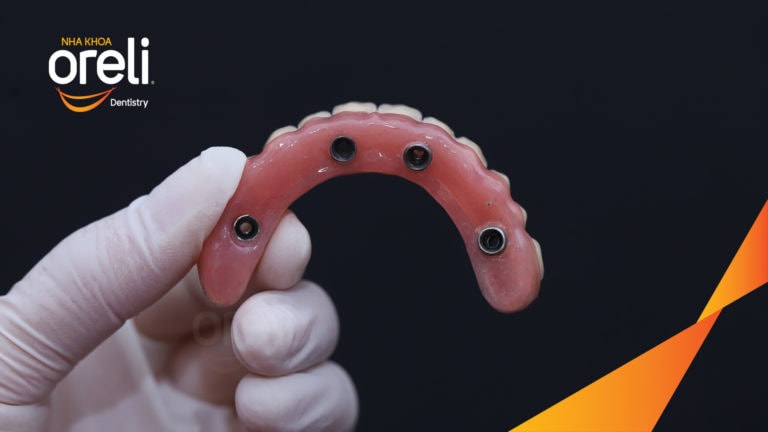 Trồng răng all on four hàm trên và dưới – Khôi phục ăn nhai trở lại | Oreli