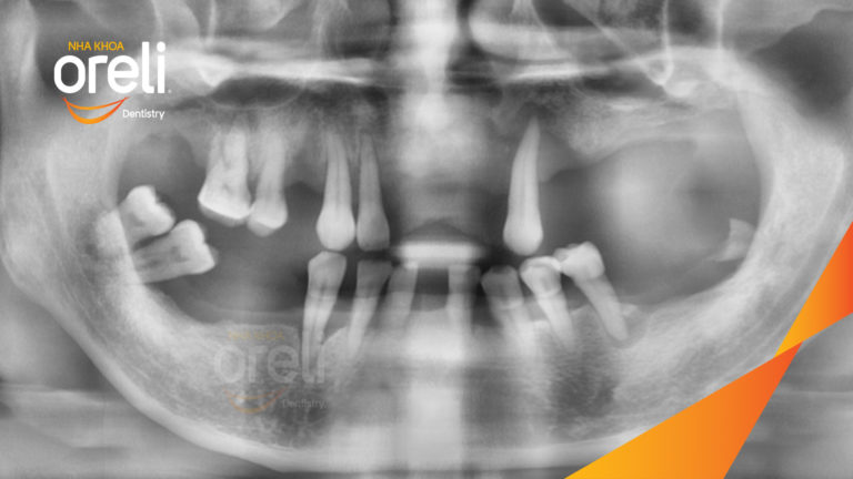 Trồng răng all on four hàm trên và dưới – Khôi phục ăn nhai trở lại | Oreli