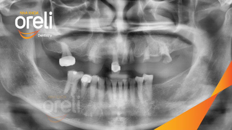 Kết quả Implant hàm trên – Khôi phục răng mất hiệu quả | Oreli