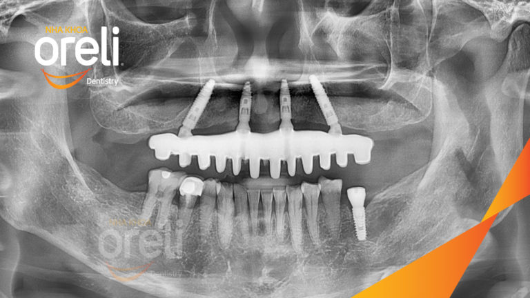 Kết quả Implant hàm trên – Khôi phục răng mất hiệu quả | Oreli