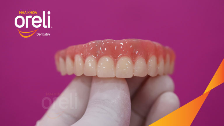 Kết quả Implant hàm trên – Khôi phục răng mất hiệu quả | Oreli