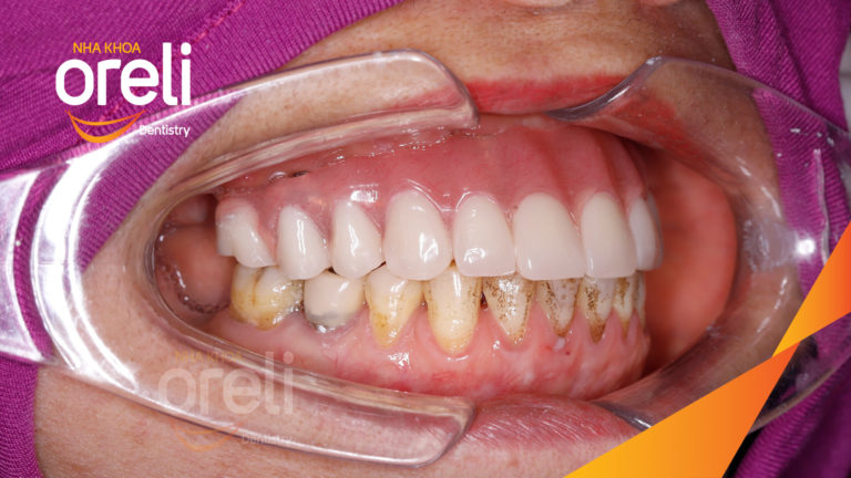 Kết quả Implant hàm trên – Khôi phục răng mất hiệu quả | Oreli