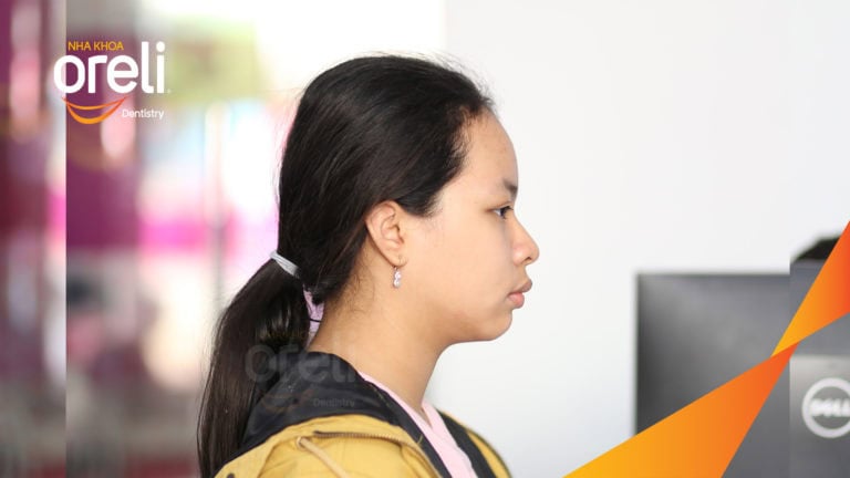 Ca cắn sâu lùi cằm răng chen chúc kết quả sau 3 năm niềng răng