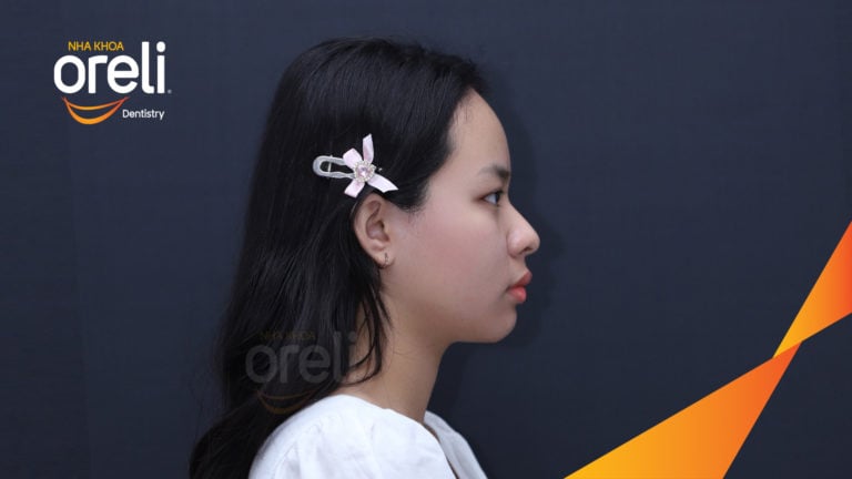 Ca cắn sâu lùi cằm răng chen chúc kết quả sau 3 năm niềng răng