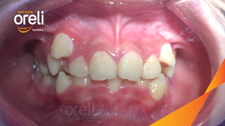 Ca cắn sâu lùi cằm răng chen chúc kết quả sau 3 năm niềng răng