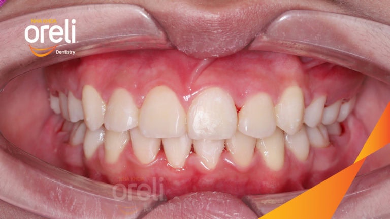 Ca cắn sâu lùi cằm răng chen chúc kết quả sau 3 năm niềng răng