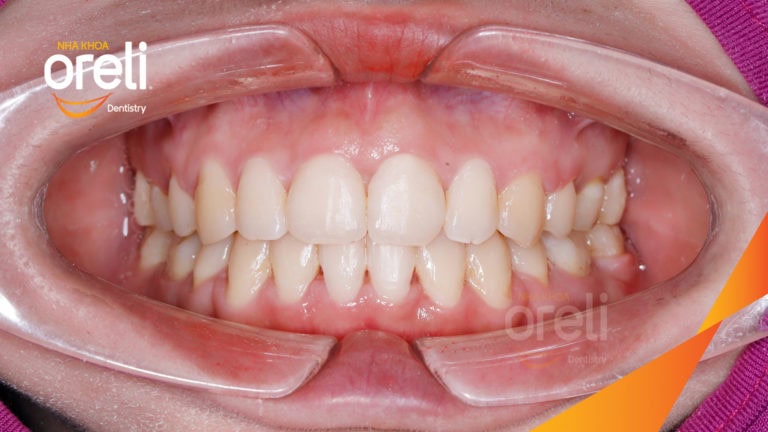 Niềng răng bằng kỹ thuật MEAW kết quả khớp cắn đẹp tại Nha Khoa Oreli