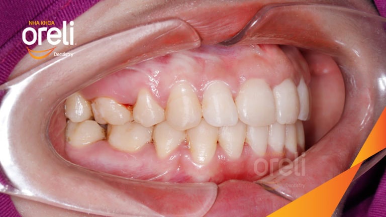 Niềng răng bằng kỹ thuật MEAW kết quả khớp cắn đẹp tại Nha Khoa Oreli