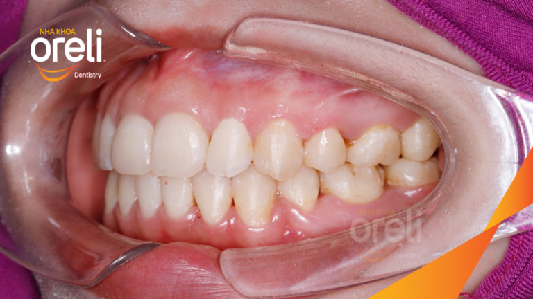 Niềng răng bằng kỹ thuật MEAW kết quả khớp cắn đẹp tại Nha Khoa Oreli