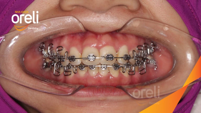 Niềng răng bằng kỹ thuật MEAW kết quả khớp cắn đẹp tại Nha Khoa Oreli