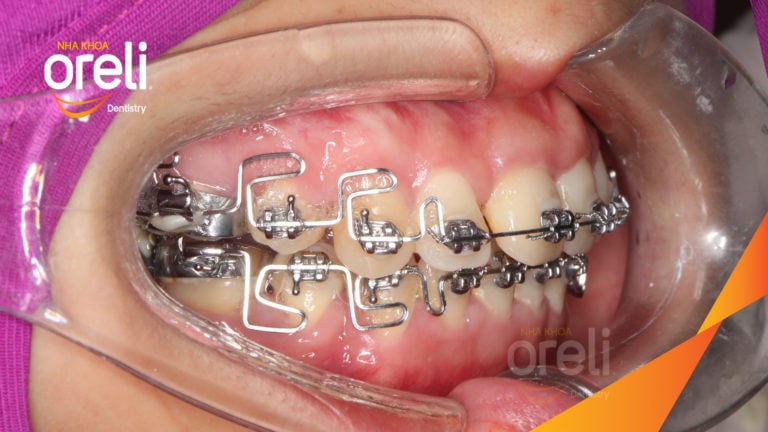 nieng rang uy tin bmt nha khoa oreli