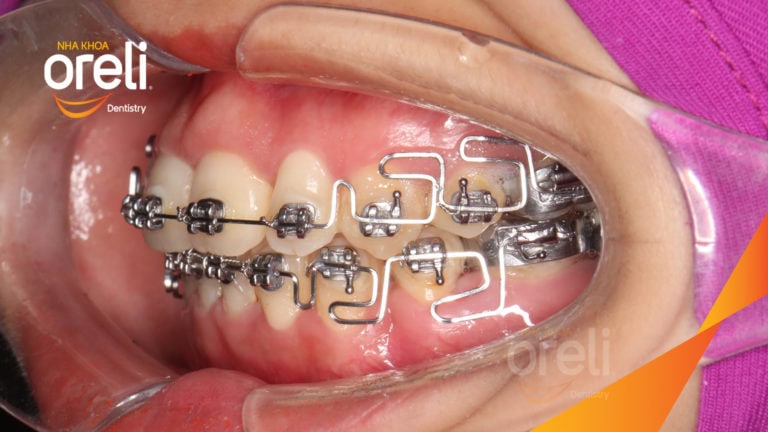 Niềng răng bằng kỹ thuật MEAW kết quả khớp cắn đẹp tại Nha Khoa Oreli