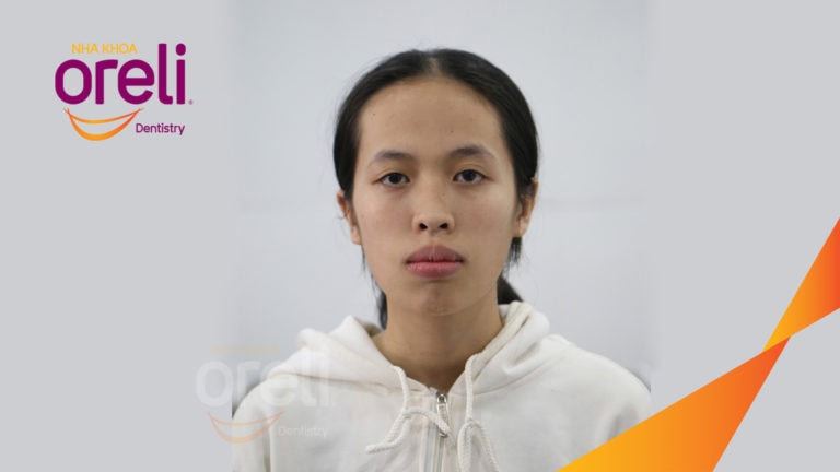 nieng rang chinh ho nha khoa oreli