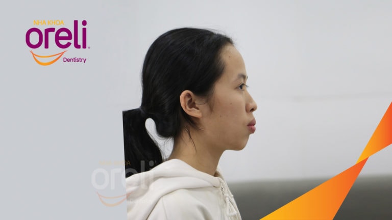 Ca chỉnh hô bằng niềng răng – thay đổi rõ nét sau quá trình điều trị tại Oreli