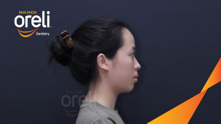 Ca chỉnh hô bằng niềng răng – thay đổi rõ nét sau quá trình điều trị tại Oreli