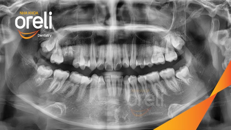 Ca chỉnh hô bằng niềng răng – thay đổi rõ nét sau quá trình điều trị tại Oreli