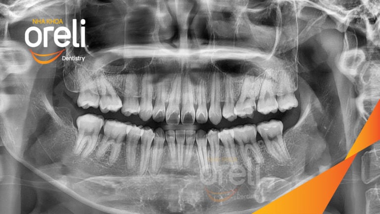 Ca chỉnh hô bằng niềng răng – thay đổi rõ nét sau quá trình điều trị tại Oreli