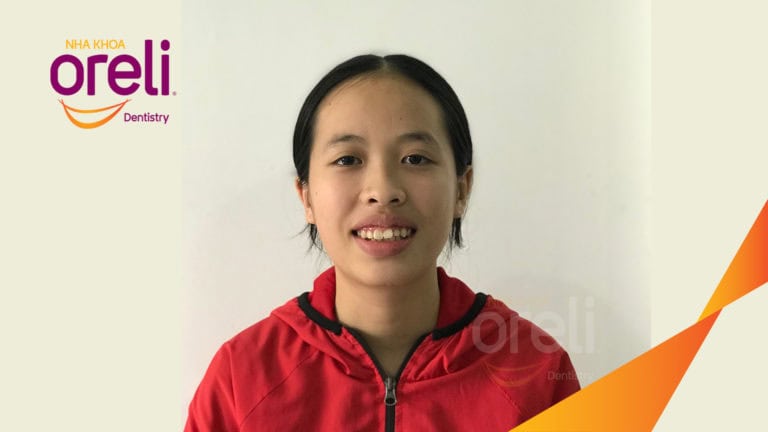 Ca chỉnh hô bằng niềng răng – thay đổi rõ nét sau quá trình điều trị tại Oreli