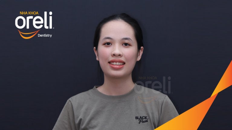 Ca chỉnh hô bằng niềng răng – thay đổi rõ nét sau quá trình điều trị tại Oreli