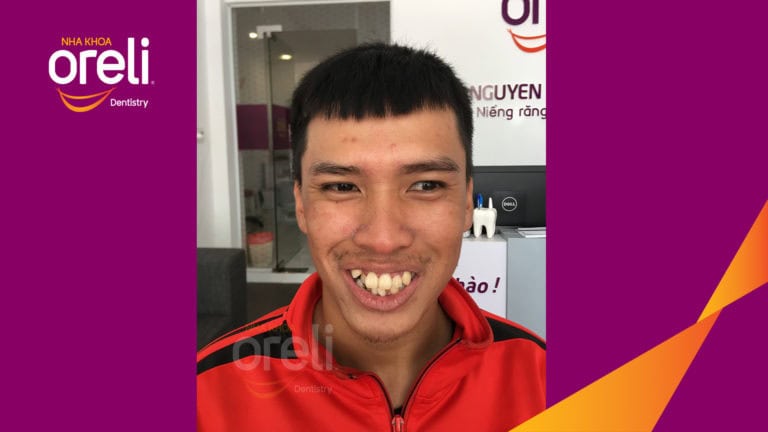 Niềng răng chỉnh hô chen chúc hai hàm mức độ nặng cải thiện khớp cắn và thẩm mỹ nụ cười tại Oreli