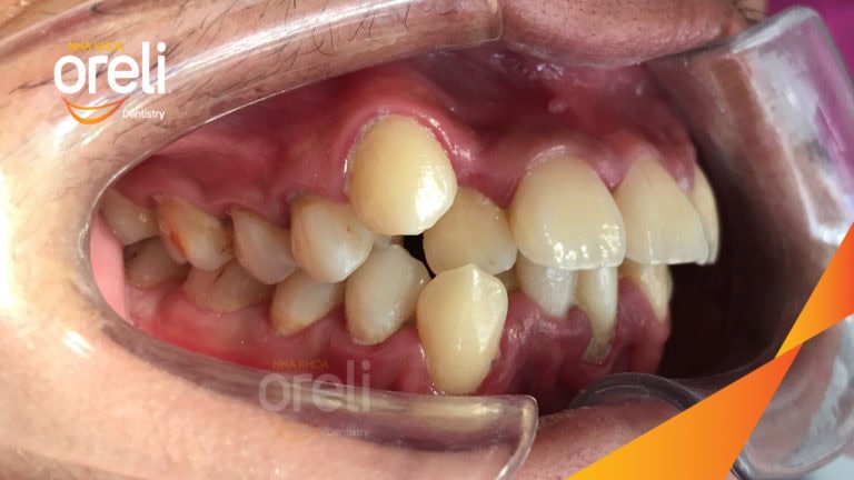 Niềng răng chỉnh hô chen chúc hai hàm mức độ nặng cải thiện khớp cắn và thẩm mỹ nụ cười tại Oreli