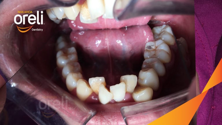 Niềng răng chỉnh hô chen chúc hai hàm mức độ nặng cải thiện khớp cắn và thẩm mỹ nụ cười tại Oreli