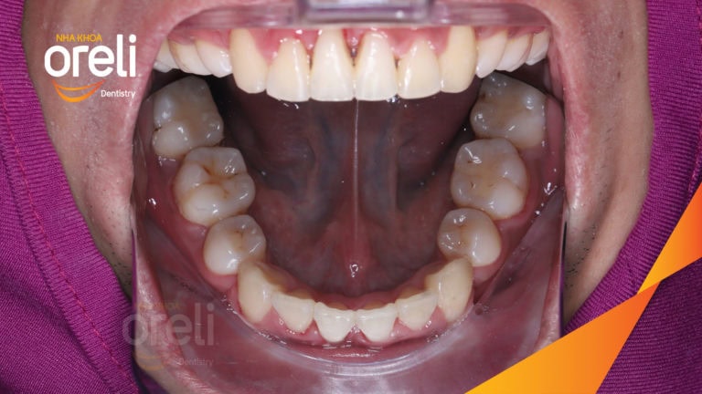 Niềng răng chỉnh hô chen chúc hai hàm mức độ nặng cải thiện khớp cắn và thẩm mỹ nụ cười tại Oreli