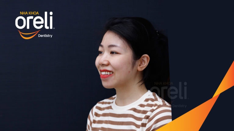 Ca niềng chỉnh cắn hở hô hai hàm kết quả sau 2 năm tại Oreli