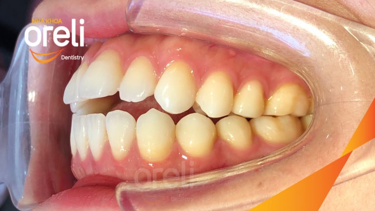 Ca niềng chỉnh cắn hở hô hai hàm kết quả sau 2 năm tại Oreli
