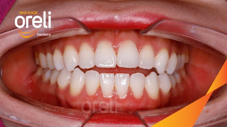 Ca niềng chỉnh cắn hở hô hai hàm kết quả sau 2 năm tại Oreli