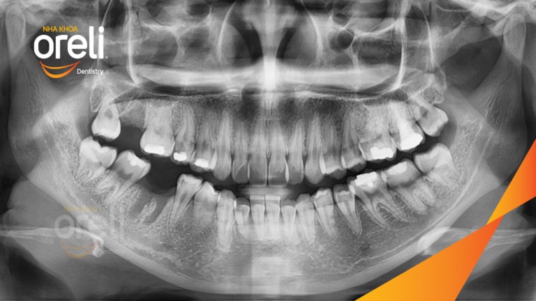 Niềng chỉnh hô và di gần răng 7 8 thay thế răng 6 kết quả thực tế tại Oreli