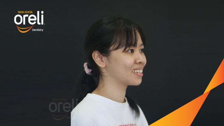 Niềng chỉnh hô và di gần răng 7 8 thay thế răng 6 kết quả thực tế tại Oreli
